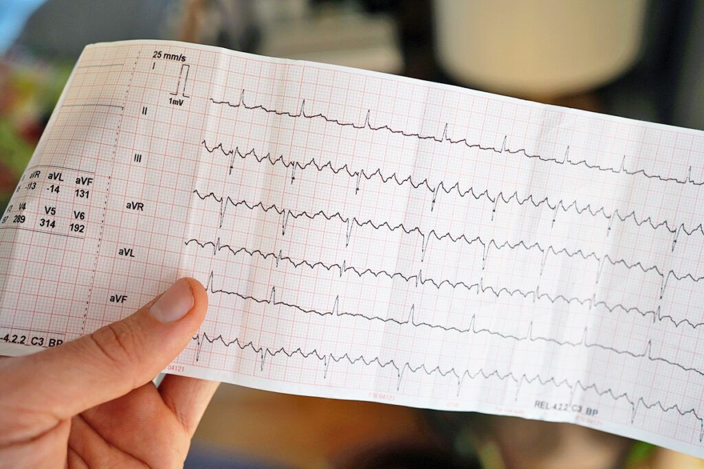 Afib on an ECG