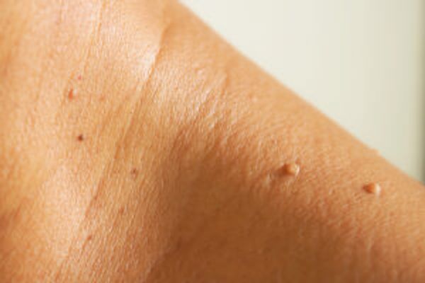 Skin tags