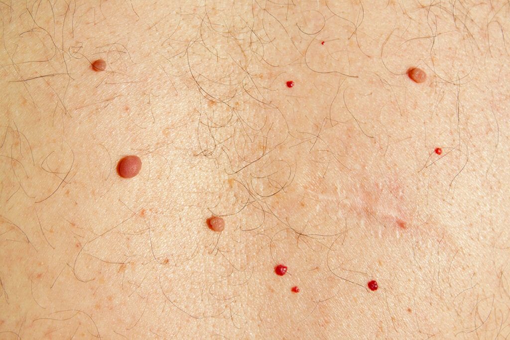 Moles and cherry angiomas