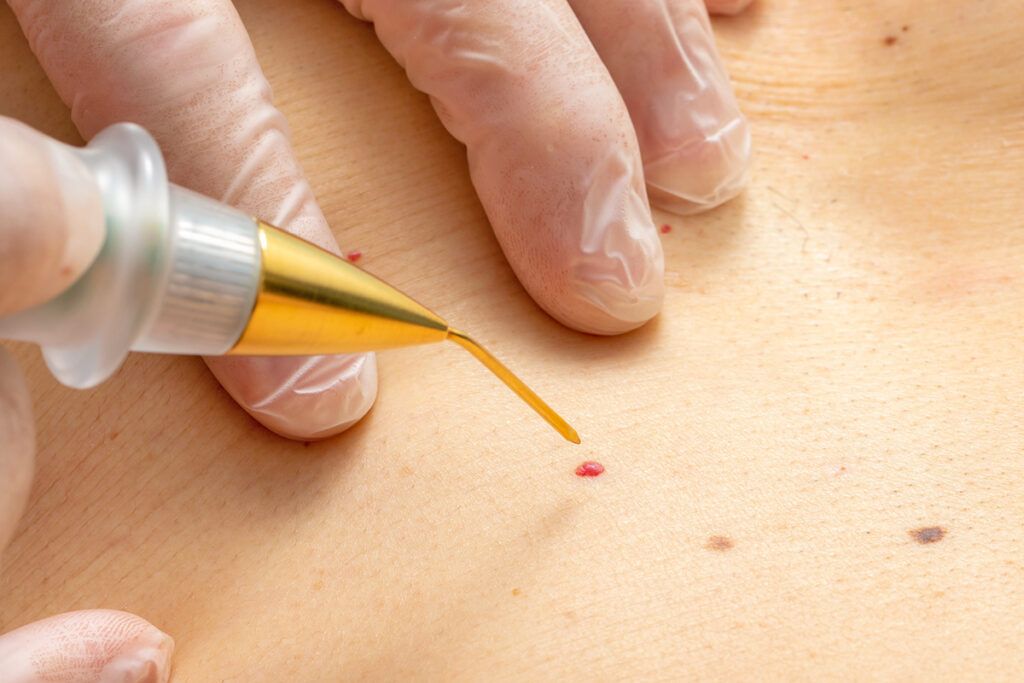 Removing cherry angioma