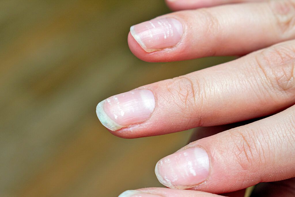 White marks on the nails