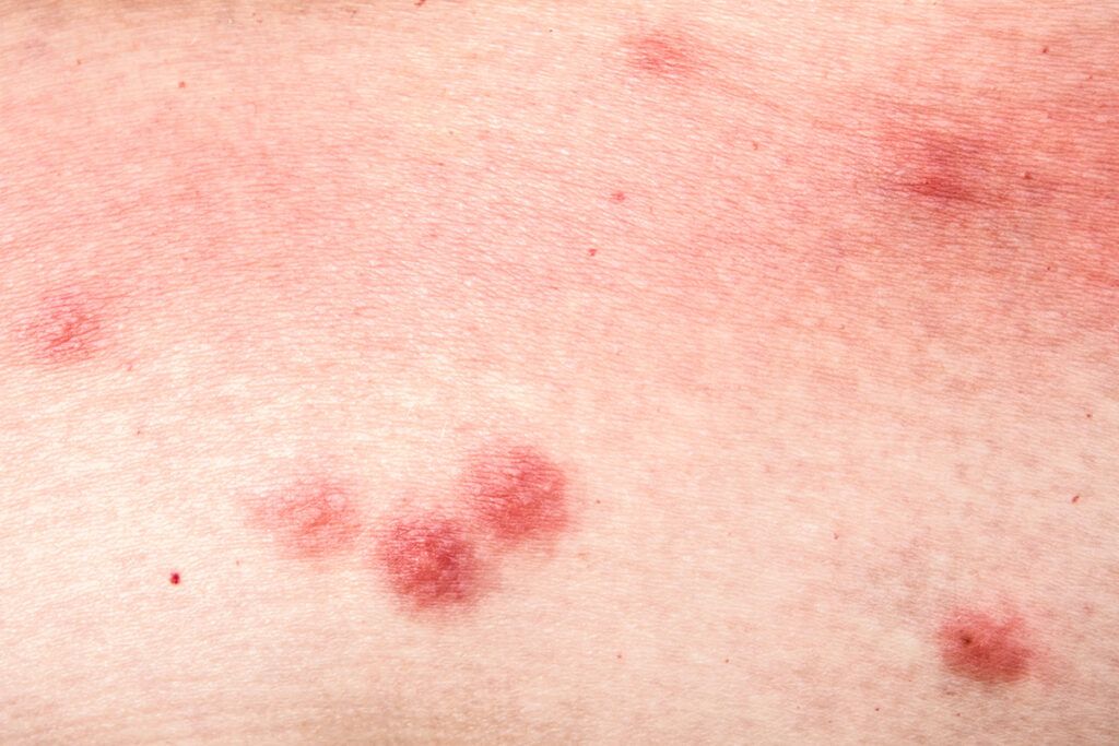 Bug bites on skin