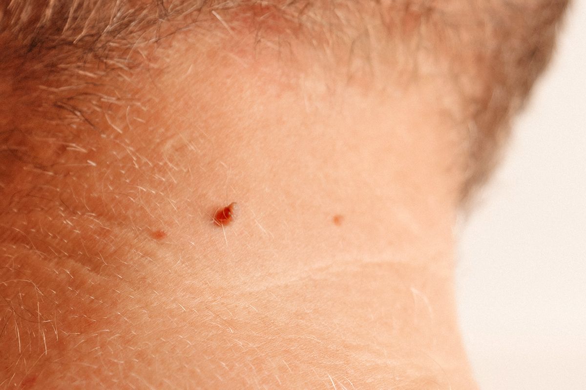 Cherry angioma