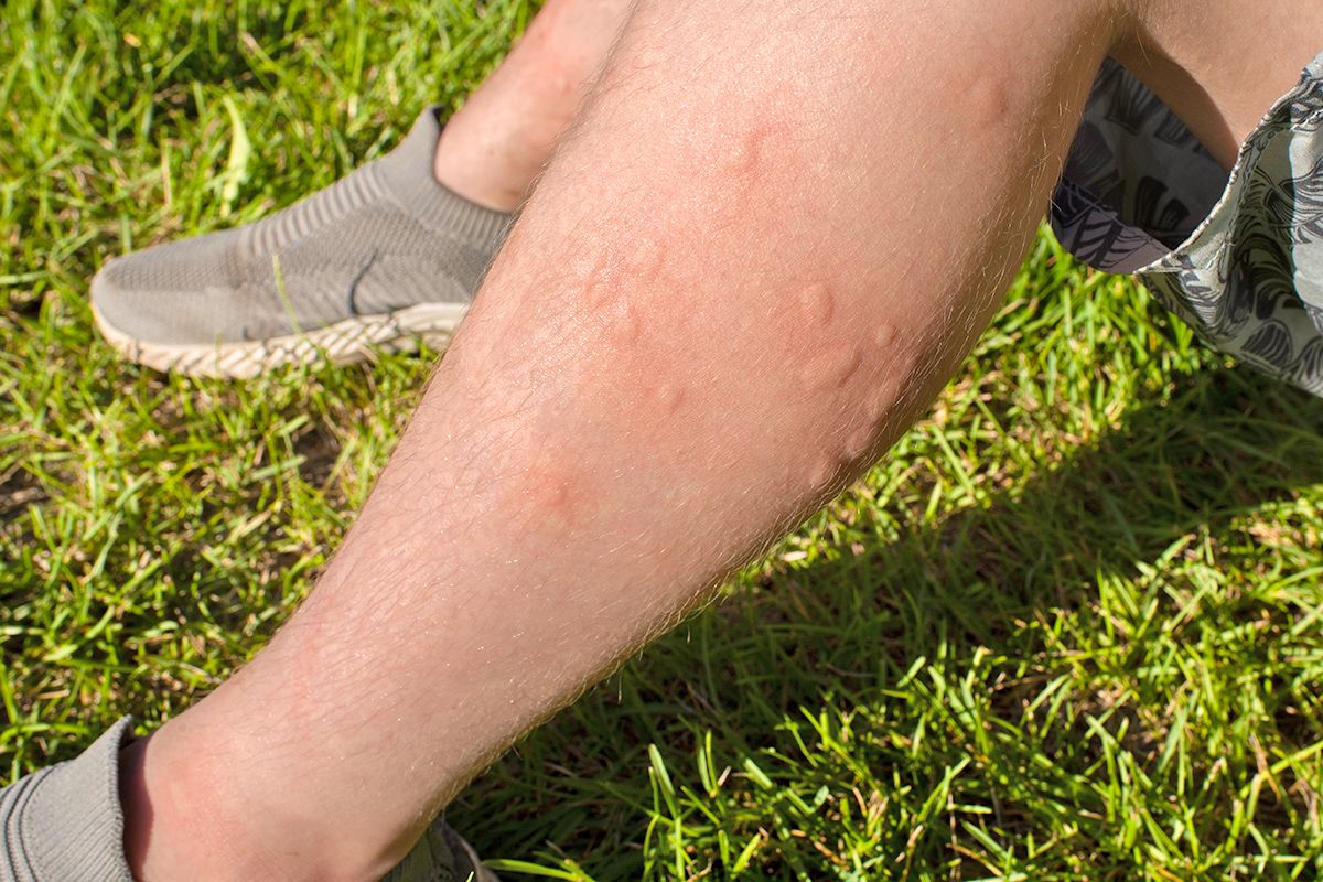 Bug bites on leg