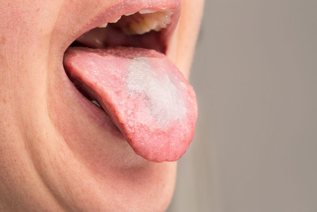 Tongue with candida overgrowth