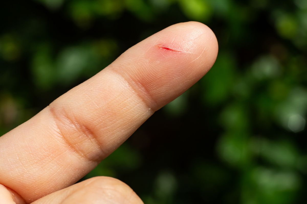 A paper cut on a fingertip