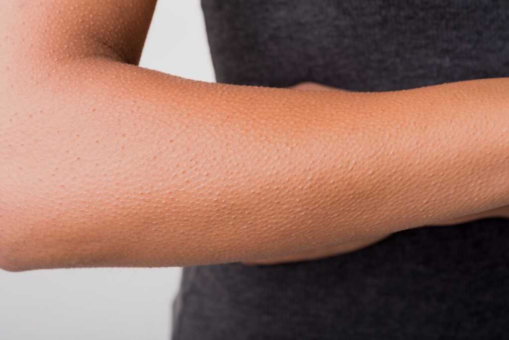 Goose bumps on an arm
